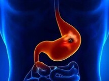 24岁女子忍腹痛一月确诊印戒细胞癌,警惕胃癌年轻化与早期伪装性