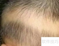 宝宝枕秃=缺钙？真相揭秘