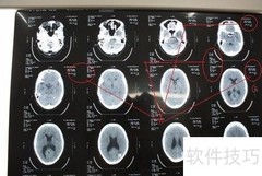 脑CT片子快速解读指南