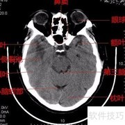 脑CT片子快速解读指南