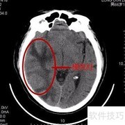 脑CT片子快速解读指南