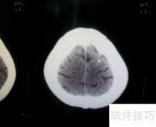 哪些人需定期做CT？一文读懂