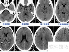 教你快速看懂头颅CT