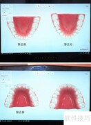 数字化正畸技术解析