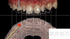 数字化种植牙全流程解析