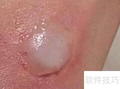 氢气球爆炸受伤如何急救