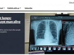 美团队研发新型人工肺，实现患者无肺生存48小时并成功移植