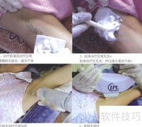 冰点脱毛原理与治疗流程