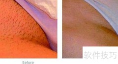 冰点脱毛价格一览