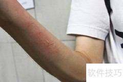 挫伤快速恢复的实用方法