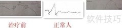 中医按摩辅助治疗弱视