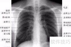 X光胸片快速解读指南