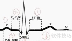 心电图T波改变解析