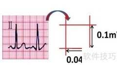 心电图T波改变解析