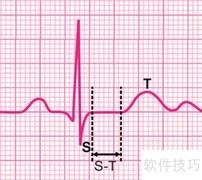 心电图T波改变解析