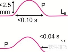 心电图T波改变解析