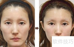 丰面颊前后对比图