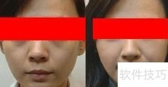 丰面颊前后对比图
