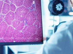 FDA批准首款AI工具AIM-NASH辅助脂肪肝临床试验评估