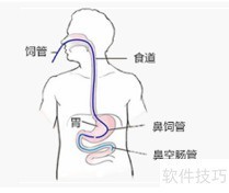 菌群移植方法解析