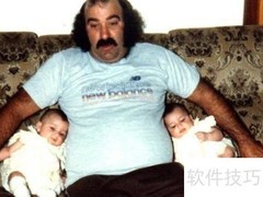 双胞胎整容前后大对比