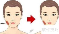 打瘦脸针要麻醉吗？