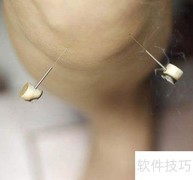 针灸缓解前列腺炎