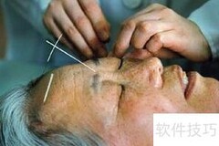 针灸能治失眠吗？