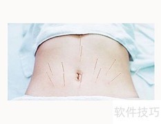 针灸减肥，重塑美丽曲线