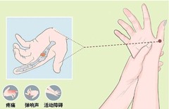 小拇指凹坑，就是新时代的“手机病”