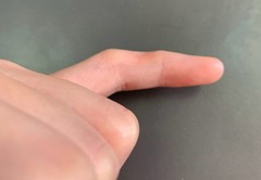 小拇指凹坑，就是新时代的“手机病”