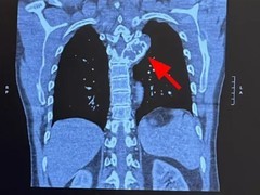 GitLab联合创始人以AI驱动个性化抗癌，实现罕见骨肉瘤临床逆转