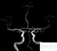 脑CT血管造影正常影像解析