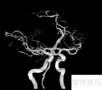 脑CT血管造影正常影像解析