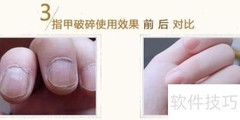 灰指甲用药全解析
