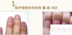灰指甲用药全解析