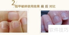 灰指甲用药全解析