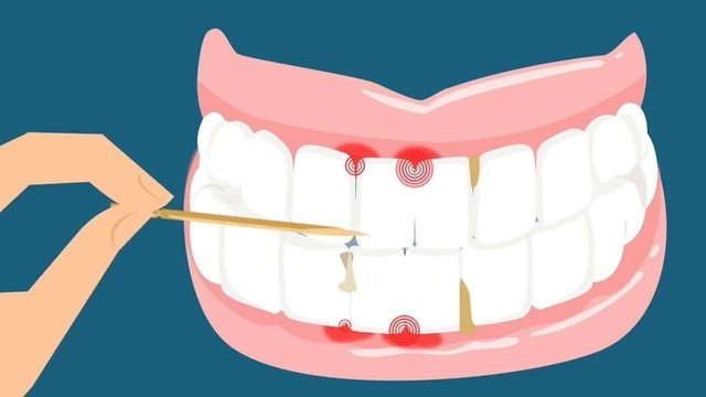 牙龈萎缩,牙间隙增大而导致牙周疾病,切不可将牙签用力压入牙间乳头区
