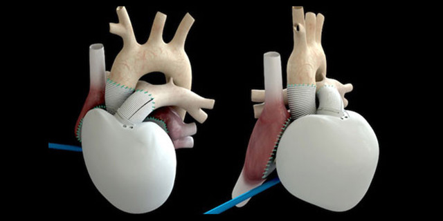 科技史上10月23日世界首例电动心脏移植