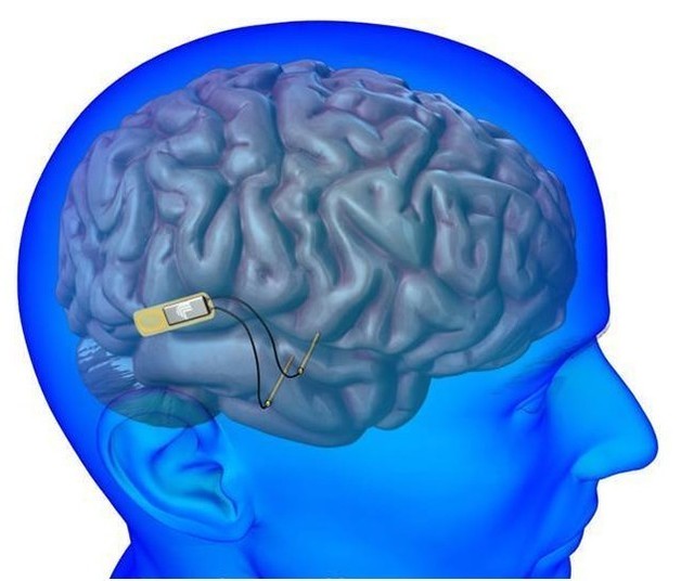 植入體內控制大腦的ai芯片已完成人體試驗